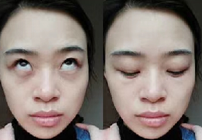 去眼袋手术