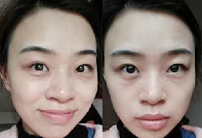 去眼袋手术