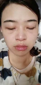 去眼袋手术
