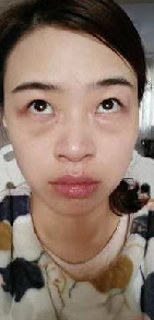 去眼袋手术