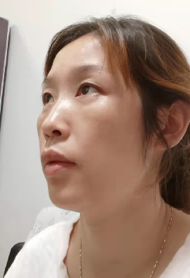 去眼袋手术