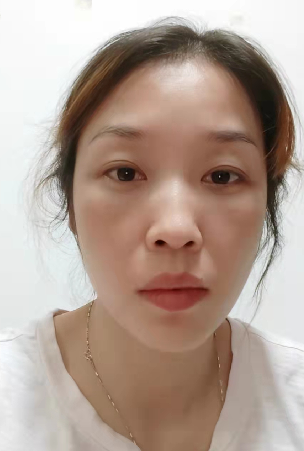 去眼袋手术