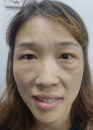 去眼袋手术