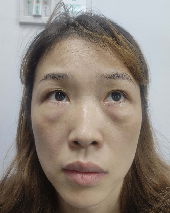 去眼袋手术