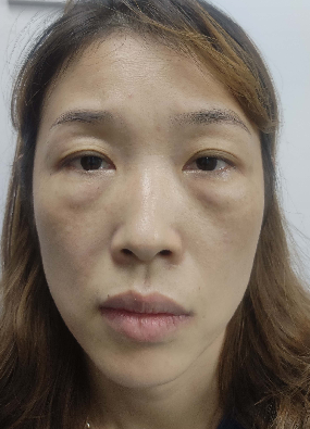去眼袋手术