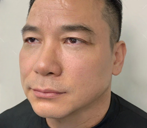 去眼袋手术