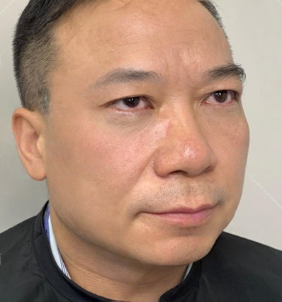去眼袋手术