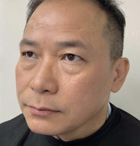 去眼袋手术