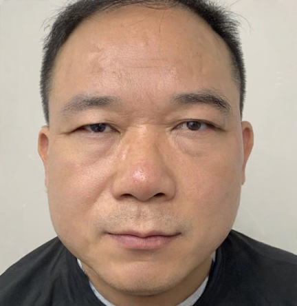 去眼袋手术