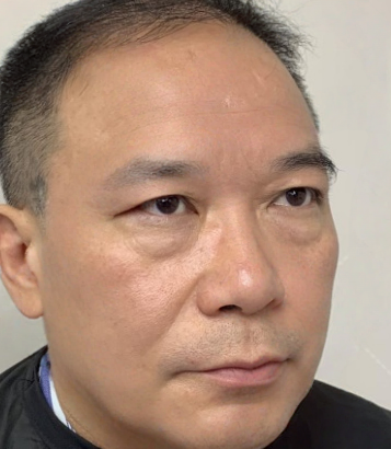 去眼袋手术