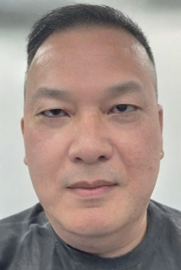 去眼袋手术