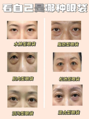 去眼袋手术