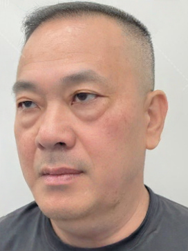 去眼袋手术