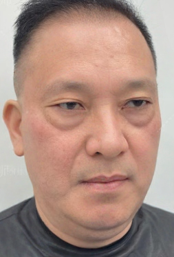 去眼袋手术