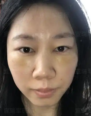 去眼袋手术