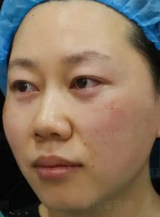 去眼袋手术