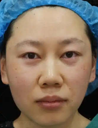 去眼袋手术