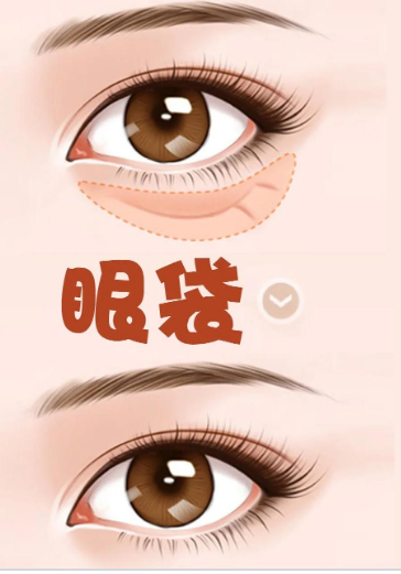 去眼袋手术