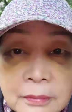 去眼袋手术