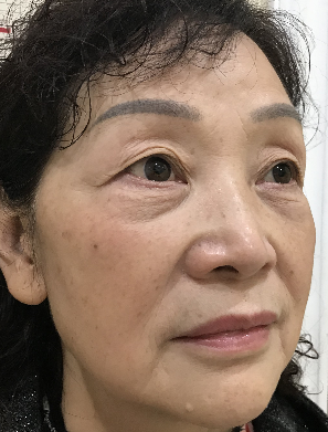 去眼袋手术
