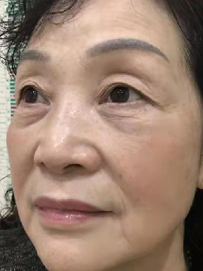 去眼袋手术