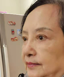 去眼袋手术