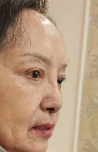 去眼袋手术