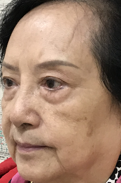 去眼袋手术