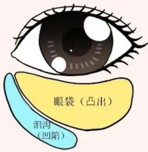 去眼袋手术