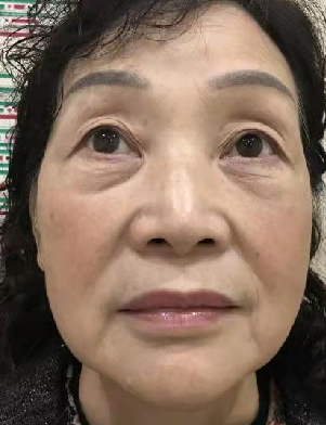 去眼袋手术