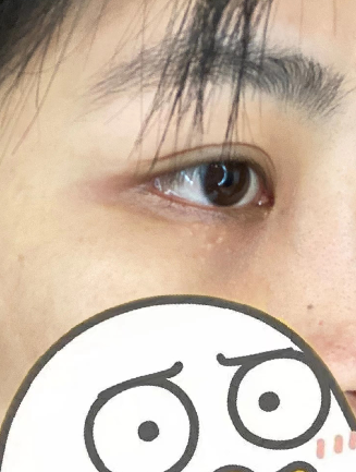 去眼袋手术