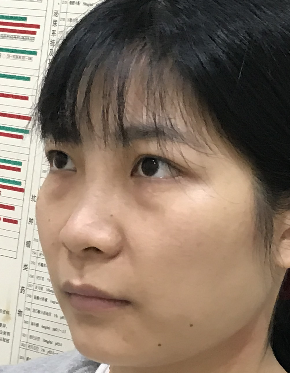 去眼袋手术