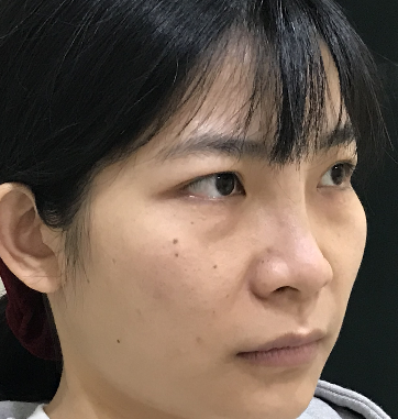去眼袋手术