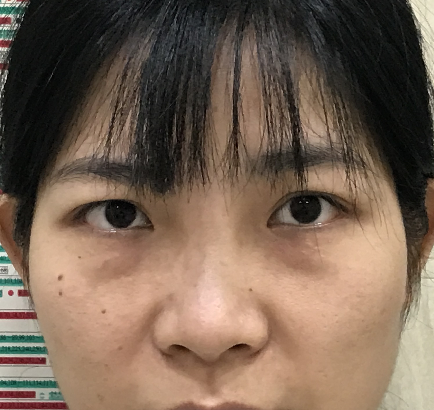 去眼袋手术