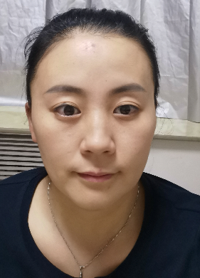 去眼袋手术