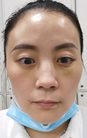 去眼袋手术