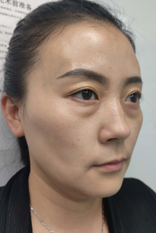 去眼袋手术