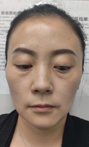 去眼袋手术