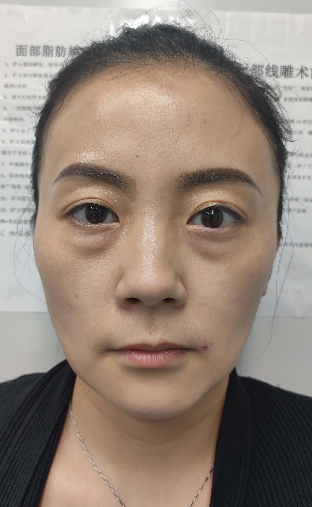 去眼袋手术