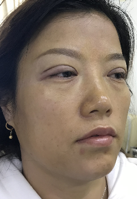 去眼袋手术