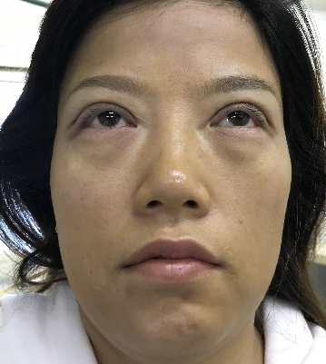 去眼袋手术