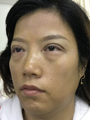 去眼袋手术