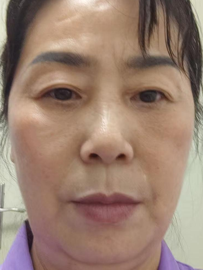 去眼袋手术