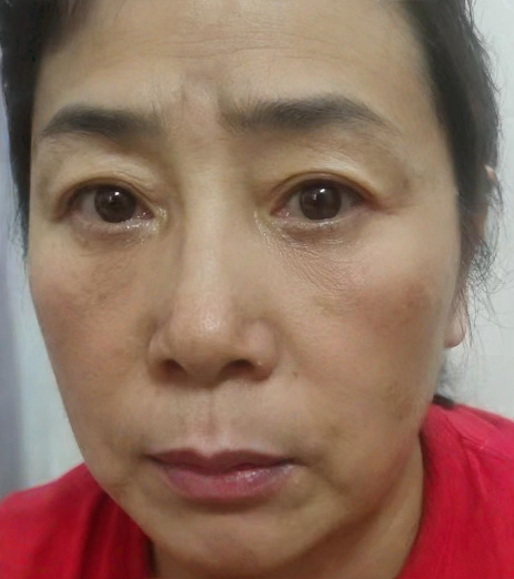 去眼袋手术