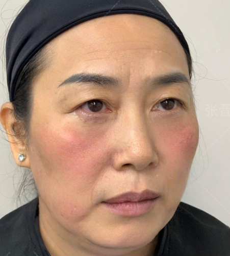 去眼袋手术