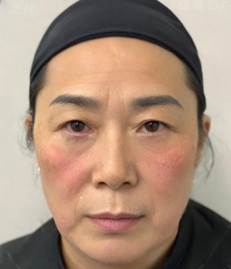 去眼袋手术