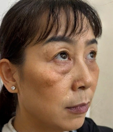 去眼袋手术