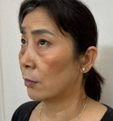 去眼袋手术