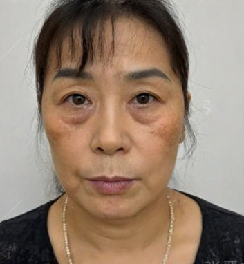 去眼袋手术
