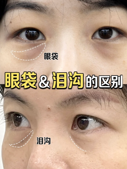 眼袋